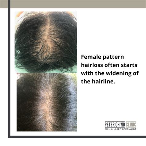 How Do I Know If Im Losing My Hair Signs Of Hair Loss Peter Ch Ng