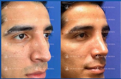 Casos De Rinoplastia Est Tica Mas D Ti Facial