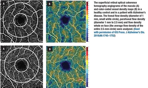 Retinal Imaging And Neurodegenerative Disease