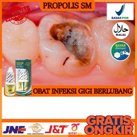 Jual Obat Alami Infeksi Gigi Berlubang Gigi Berdarah Gigi Sakit