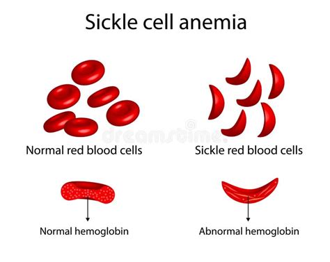 Sickle Cell People Stock Illustrations 34 Sickle Cell People Stock