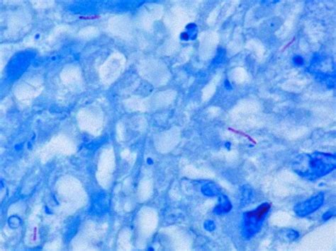 File:Mycobacterium tuberculosis Ziehl-Neelsen stain 640.jpg - Wikimedia ...