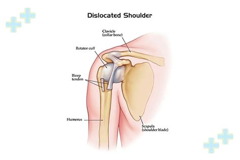 Shoulder Dislocation Treatment - Health Trawell