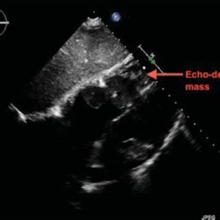 Two-dimensional transthoracic echocardiography (subcostal view) showed ...