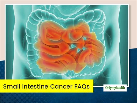 Small Intestine Cancer: Know Cause, Symptoms And Treatment Of This ‘Slow’ Killer! | OnlyMyHealth