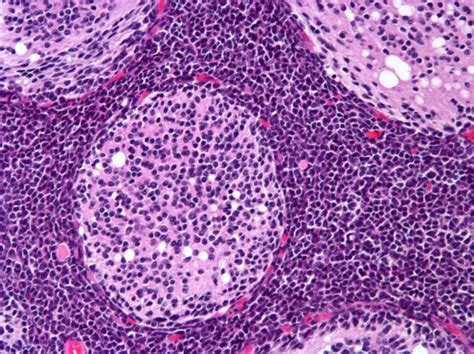 Post Pubertal And Adult Patients With Medulloblastomas Euracan