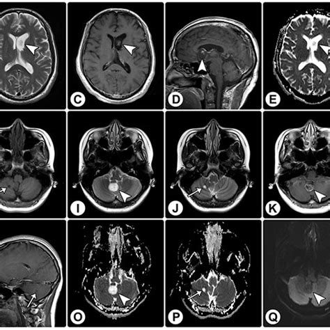 Rosette Forming Glioneuronal Tumor In The Frontal Lobe Involving The