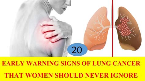 Lung Cancer Signs And Symptoms Tagalog : Is My Cough a Lung Cancer Cough? - Common lung cancer ...