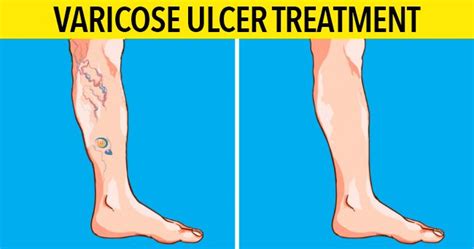 Varicose Ulcer Treatment In Mumbai Dr Ashank Bansal