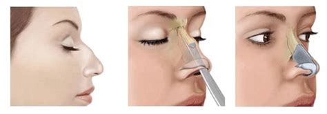 Combien Coute Une Rhinoplastie Blog Univers Med