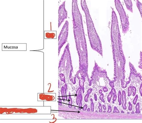 Gi Pathology Iii Flashcards Quizlet