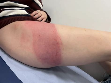 Warning Issued After Woman Burnt Alive When Hot Water Bottle Explodes