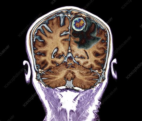 Secondary Brain Cancer Mri Scan Stock Image C040 3197 Science