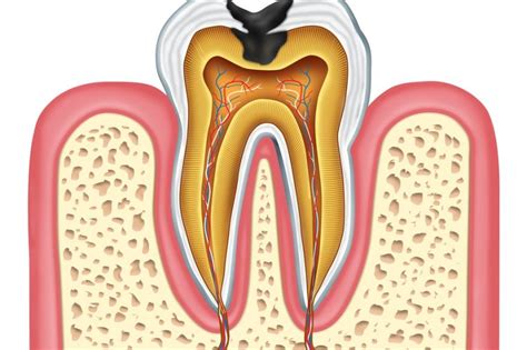 Tooth Decay Diagram