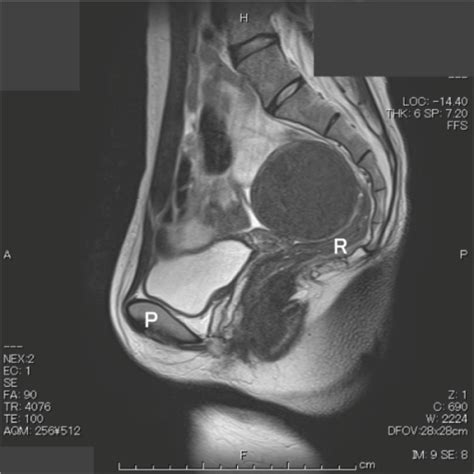 Pelvic MRI Images Are Shown Sagittal View Abbreviatio Open I