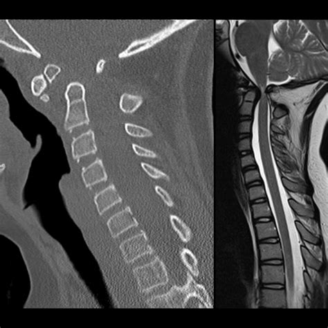 Os Odontoideum | Pediatric Radiology Reference Article | Pediatric ...