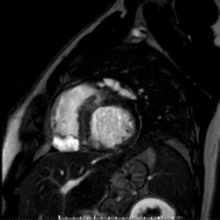 Cardiac Magnetic Resonance Imaging Showed Classic Phenotypic Features