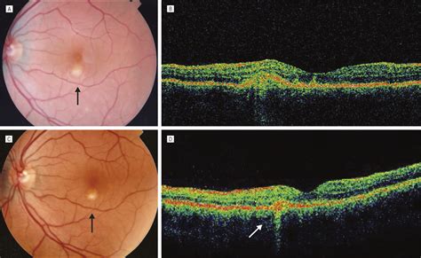 Clinical And Tomographic Features Of Macular Punctate Outer Retinal