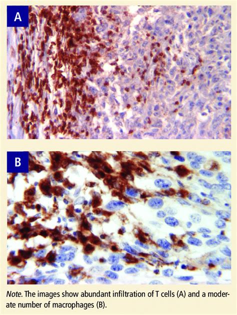 Immunohistochemical Staining Of A Resected Tumor Nodule Note Images