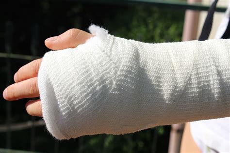 Fractura De Cúbito Y Radio Síntomas Y Tratamiento Camde