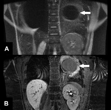 E A Precontrast Coronal T2 Weighted Single Shot Fast Spin Echo