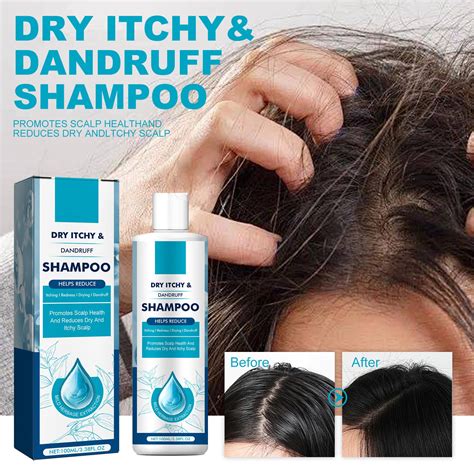 Coal Tar Dandruff Shampoo Extra Strength 2 Coal Tar Extract Medicated
