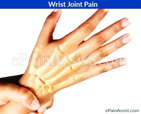 How To Treat Wrist Joint Pain At Victoria Otero Blog