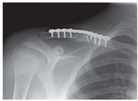 Clavicle Fractures Musculoskeletal Key