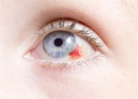 What are the complications of the scratched cornea? | Group of Top Eye