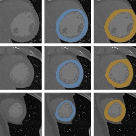 Pdf Automatic Segmentation Of The Left Ventricle In Cardiac Ct