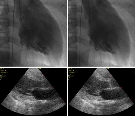 Figure Left Ventriculography Lvg Performed On Admission And