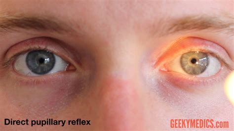 Afferent Pupillary Defect