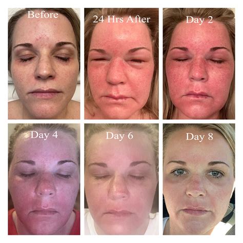 Sciton Halo Hybrid Fractional Laser | Dermatology Care of Charlotte