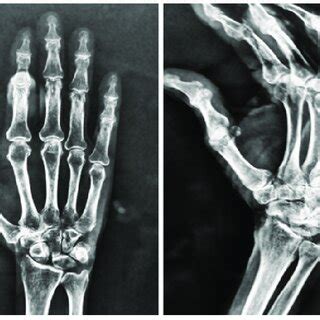 Plain Radiograph Showing Antero Posterior And Oblique View Of Right