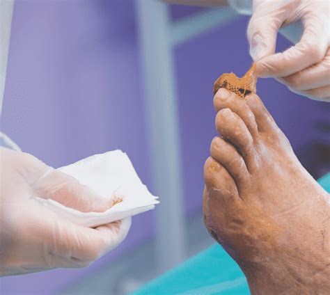Les Plaies Du Pied Chez Le Diabétique Pied Neuropathique Pied