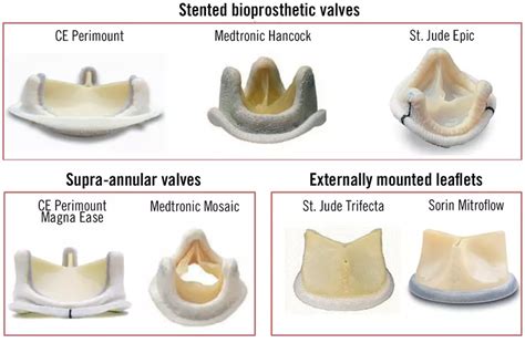 Failing Surgical Bioprosthesis In Aortic And Mitral Position