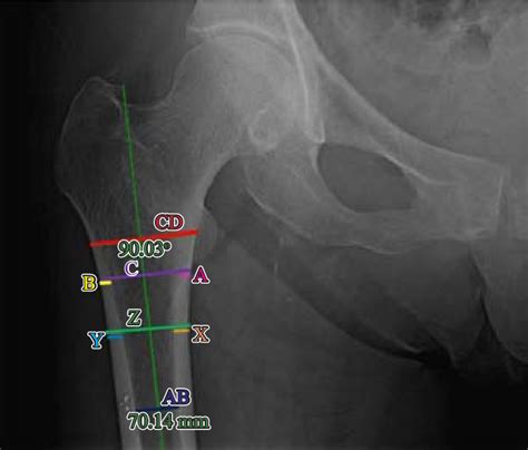 Radiografía anteroposterior de pelvis con medidas para el cál culo del