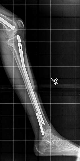 76 Equinus Contracture Correction With External Fixation Plastic
