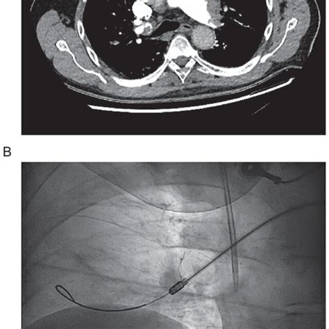 A Axial Computed Tomography Scan Of The Chest With Pulmonary Angiogram