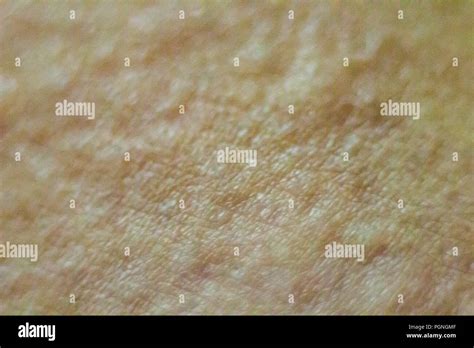 Close Up View Of Cold Urticaria Allergic Rash Symptoms Of Itchy