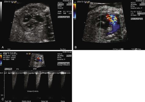 Pulmonary Stenosis Radiology Key