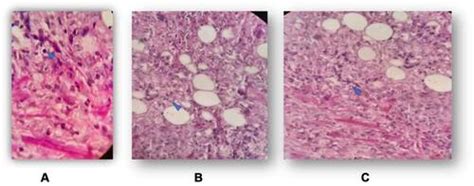 Full Article Progressive Disseminated Histoplasmosis Mimicking As Anal