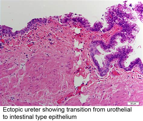Pathology Outlines Villous Adenoma