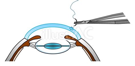 Free Vectors | Schematic diagram of cataract surgery