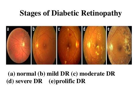 4 Stages Of Diabetic Retinopathy