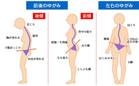 骨盤後傾が必ずしも悪いとはかぎらない