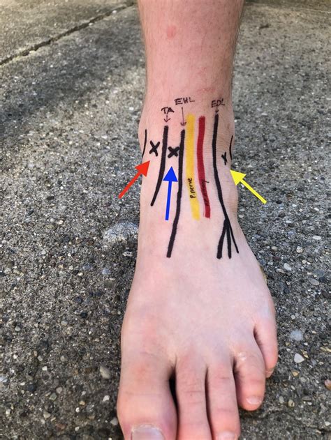 joint aspiration ankle maimonides emergency medicine residency