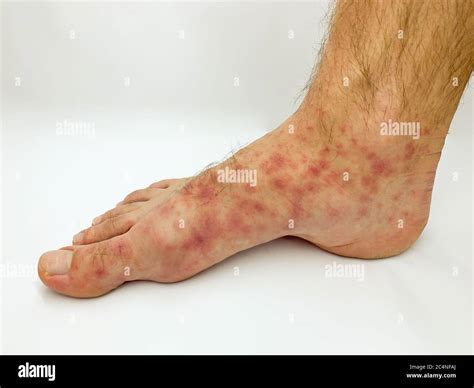 Close Up Of Male S Foot And Toes With Red Rash Desease On A White