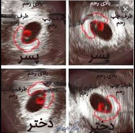 جنسیت جنین از روی عکس سونو Nt عکس تبادل نظر نی نی سایت