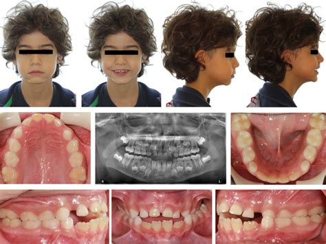 Modified Haas Expander For The Treatment Of Anterior Openbite And